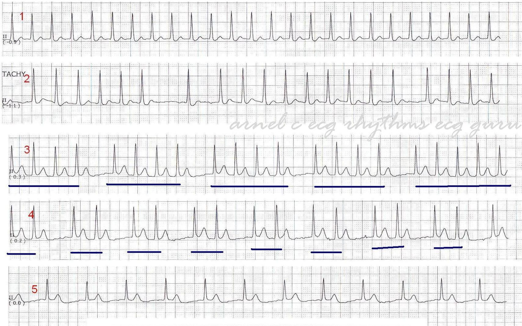 ECG Challenge Grouped Beating Double Tachycardia ECG Guru